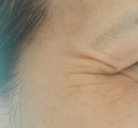 ４０代女性肝斑